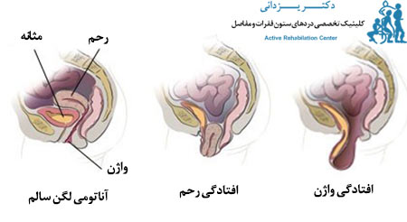 علت‌ها و دلایل افتادگی لگن در زنان